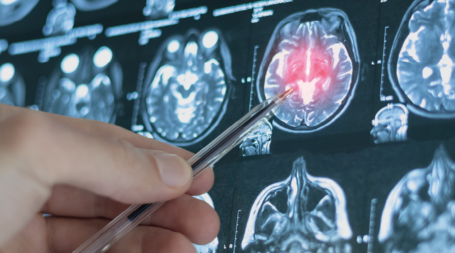 Alzheimer riski önlemlerle azaltılabiliyor